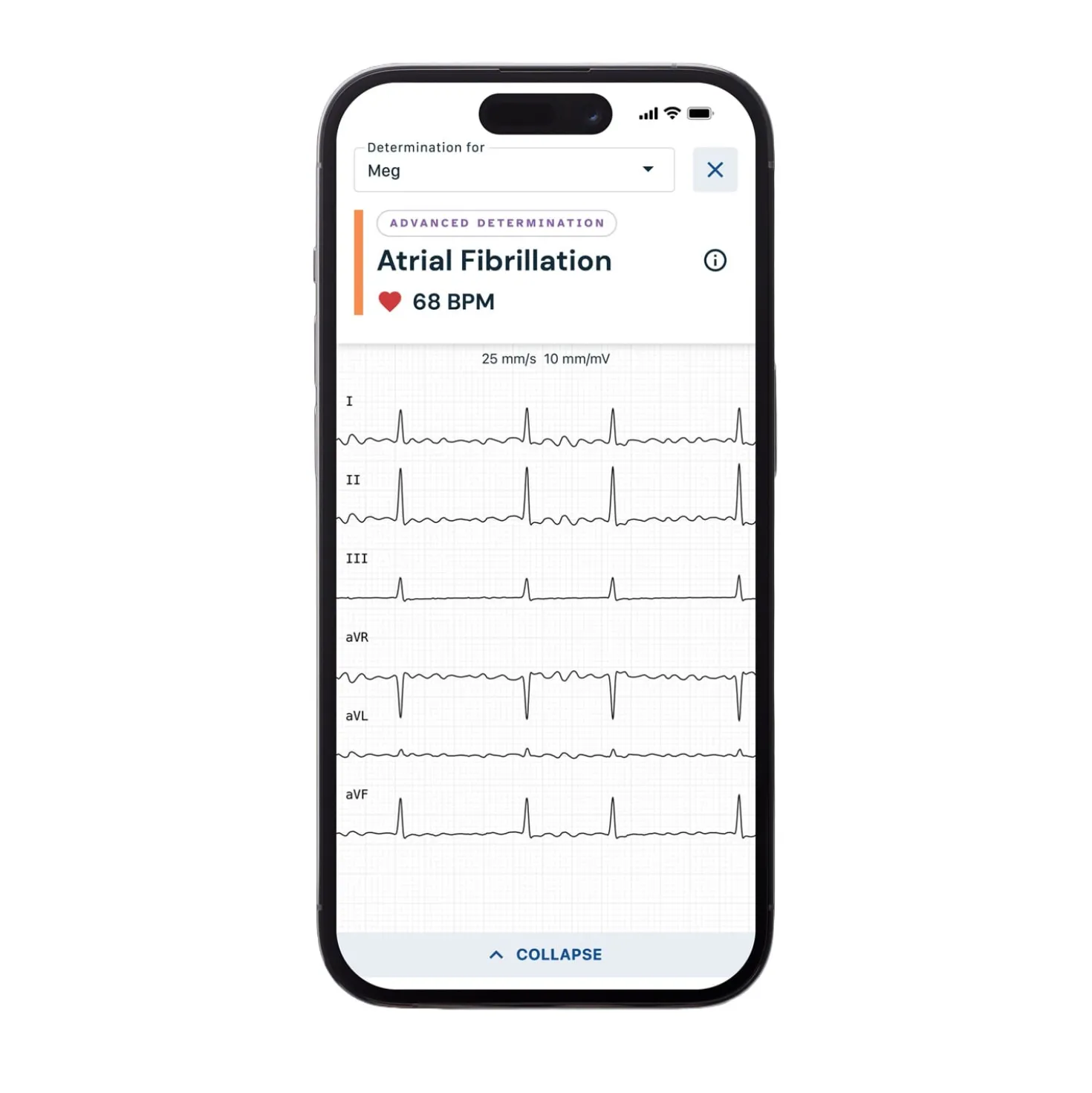 ALIVECOR® KardiaMobile®