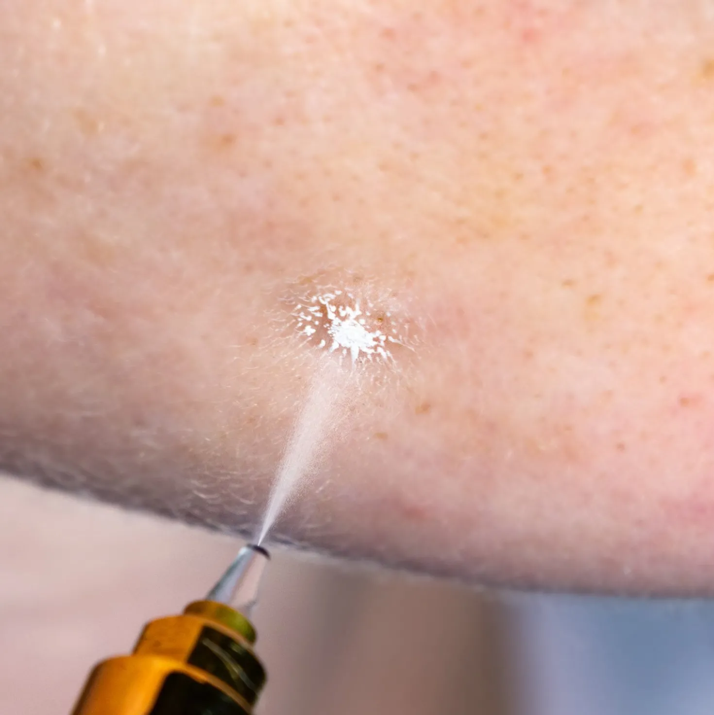 Cryoalfa SUPER