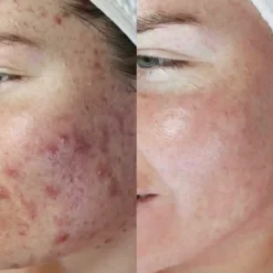 Dermalux TRI-WAVE MD