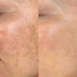 Dermalux TRI-WAVE MD