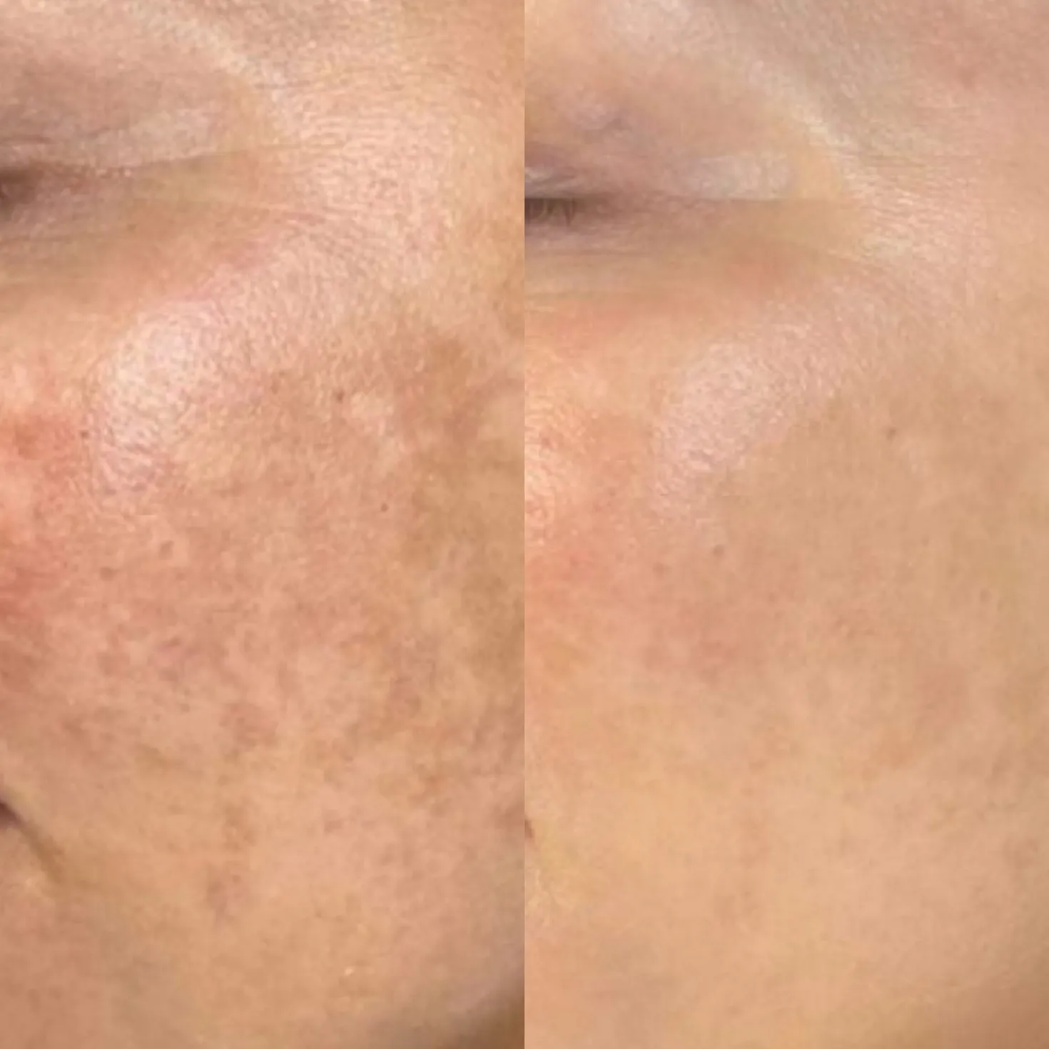 Dermalux TRI-WAVE MD