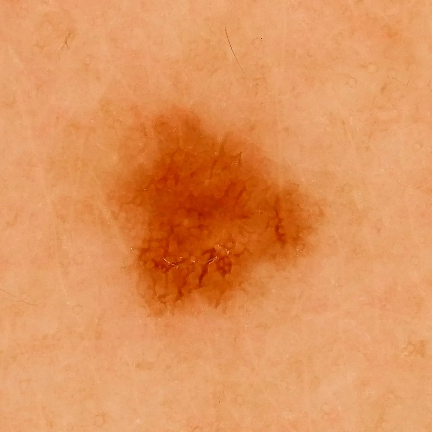 DZ-D100 Dermatologie-Kamera