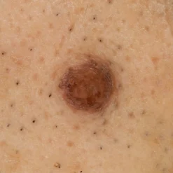 DZ-D100 Dermatologie-Kamera
