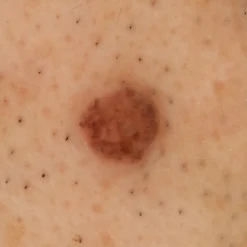 DZ-D100 Dermatologie-Kamera