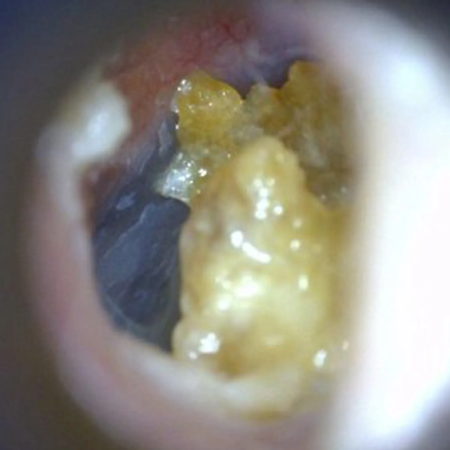 EarScope Basic