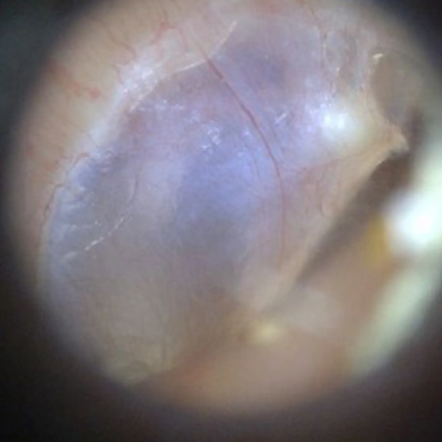 EarScope Basic