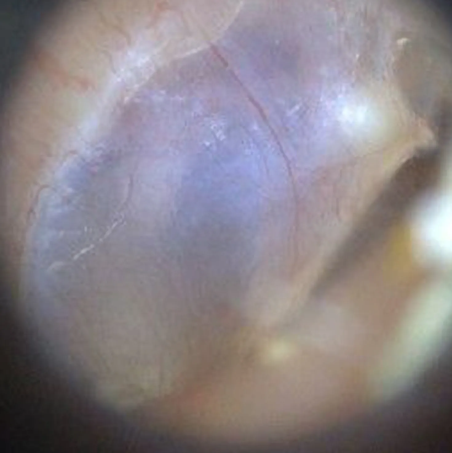 EarScope Pro (kabellos)