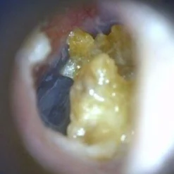 EarScope Pro (kabellos)