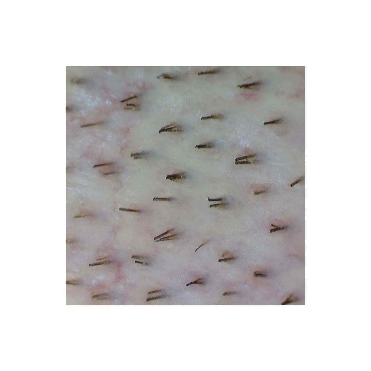«Firefly» Videodermatoskop