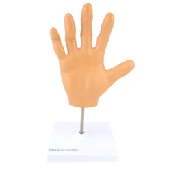 Handmodell mit rheumatoider Arthritis