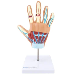 Handmodell mit rheumatoider Arthritis