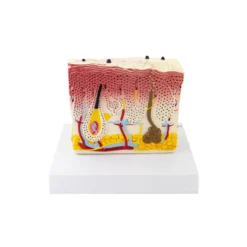 Hautmodell mit Psoriasis