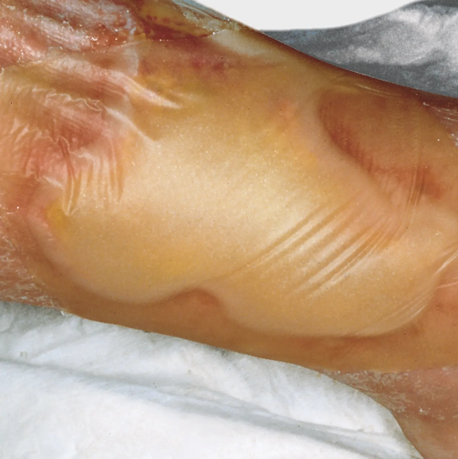 Hydrocoll Hydrokolloid-Verband