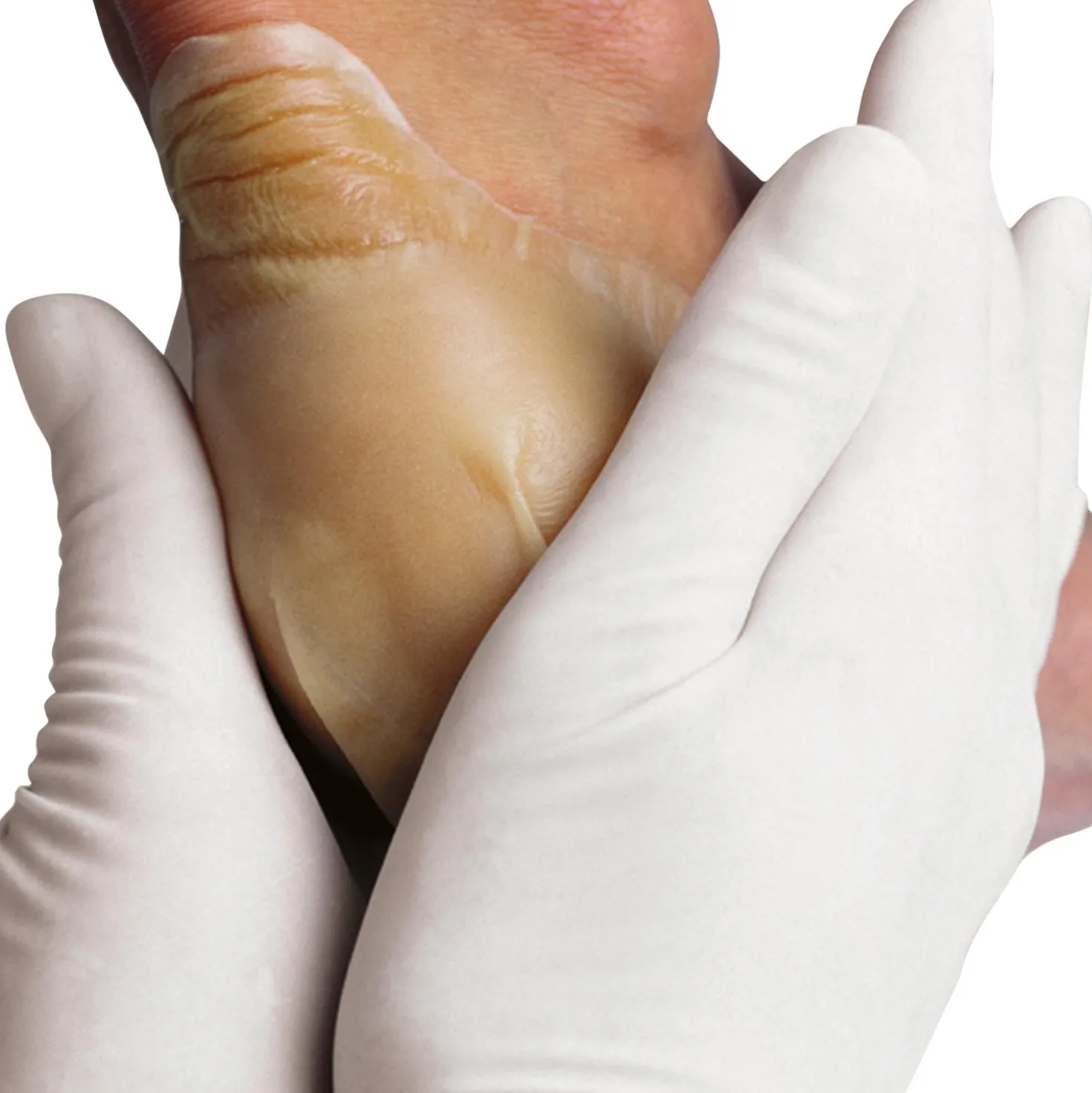 Hydrocoll Hydrokolloid-Verband