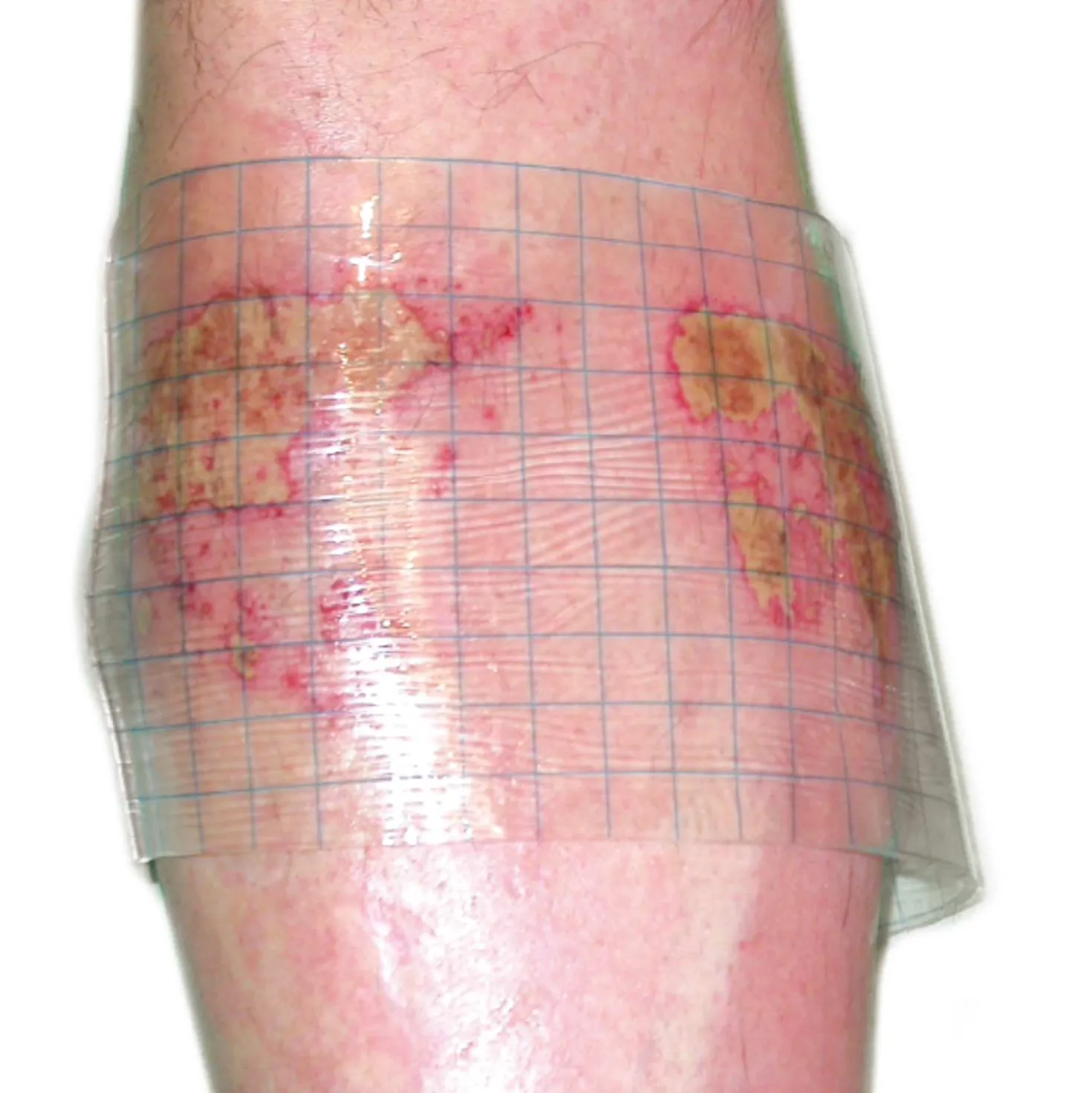 HydroTac transparent Gelverband