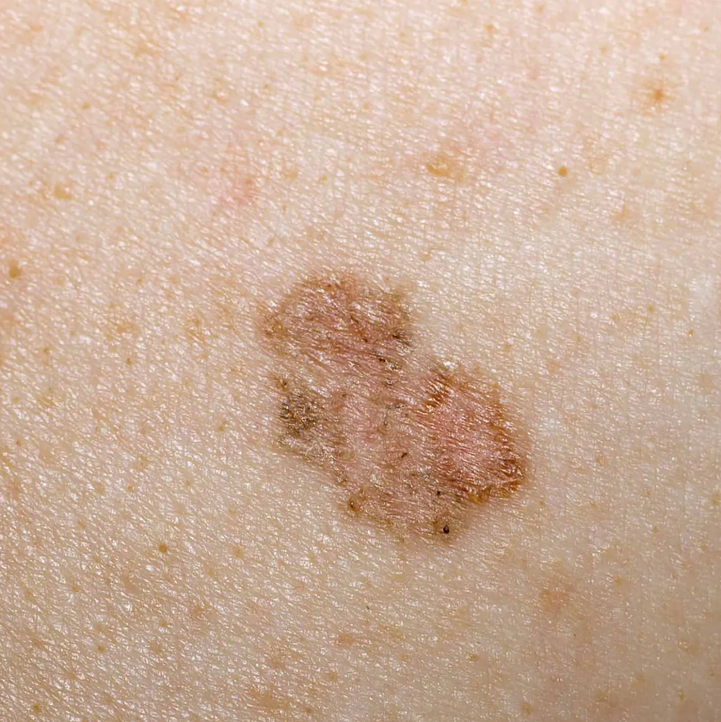 LuxaScope CCT Dermatoskop