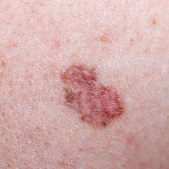 LuxaScope CCT Dermatoskop