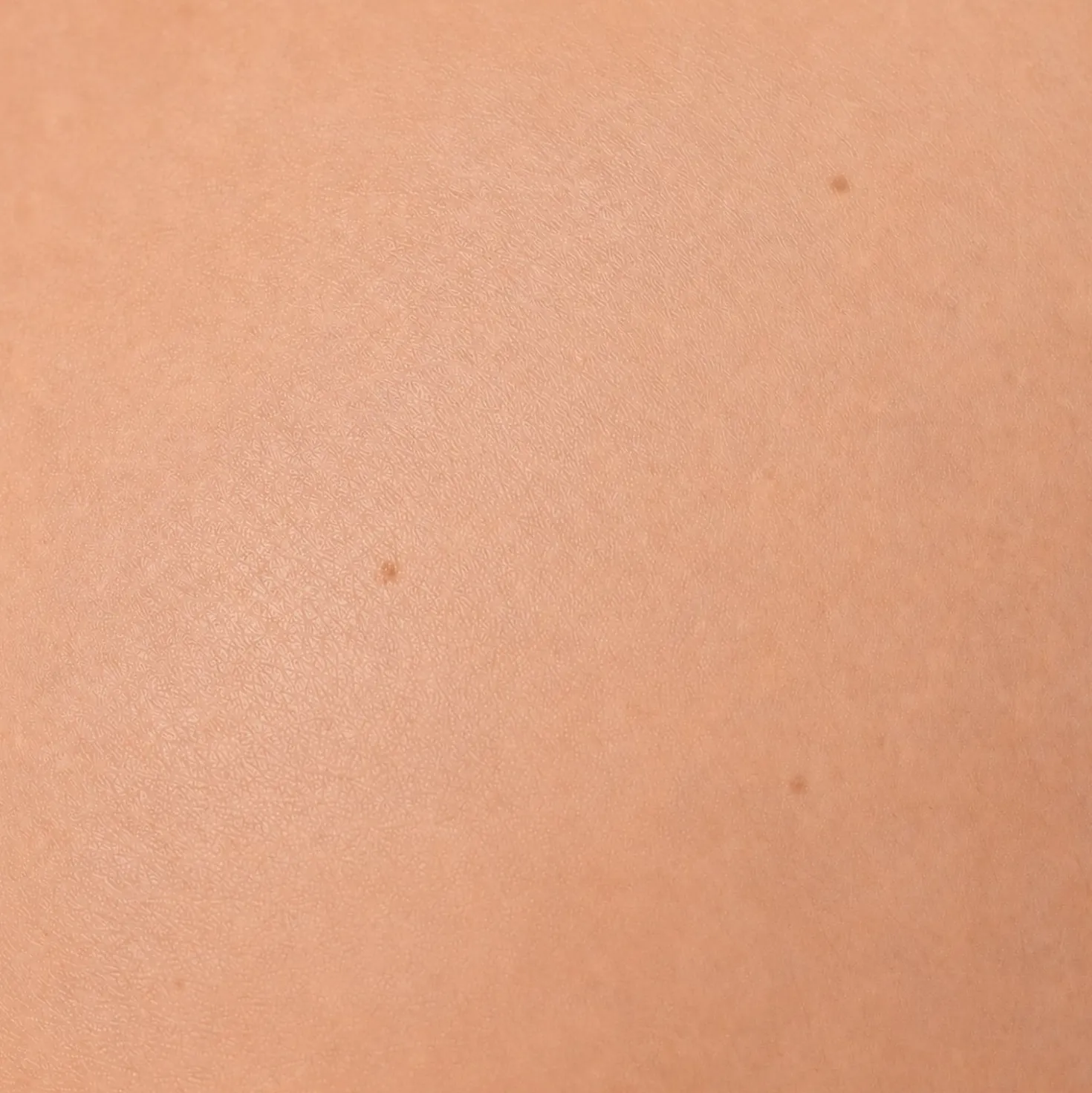 LuxaScope Dermatoskop mit Polarisationsfilter