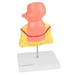 Modell Rektum mit Erkrankungen