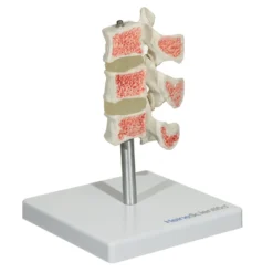Osteoporose Modell