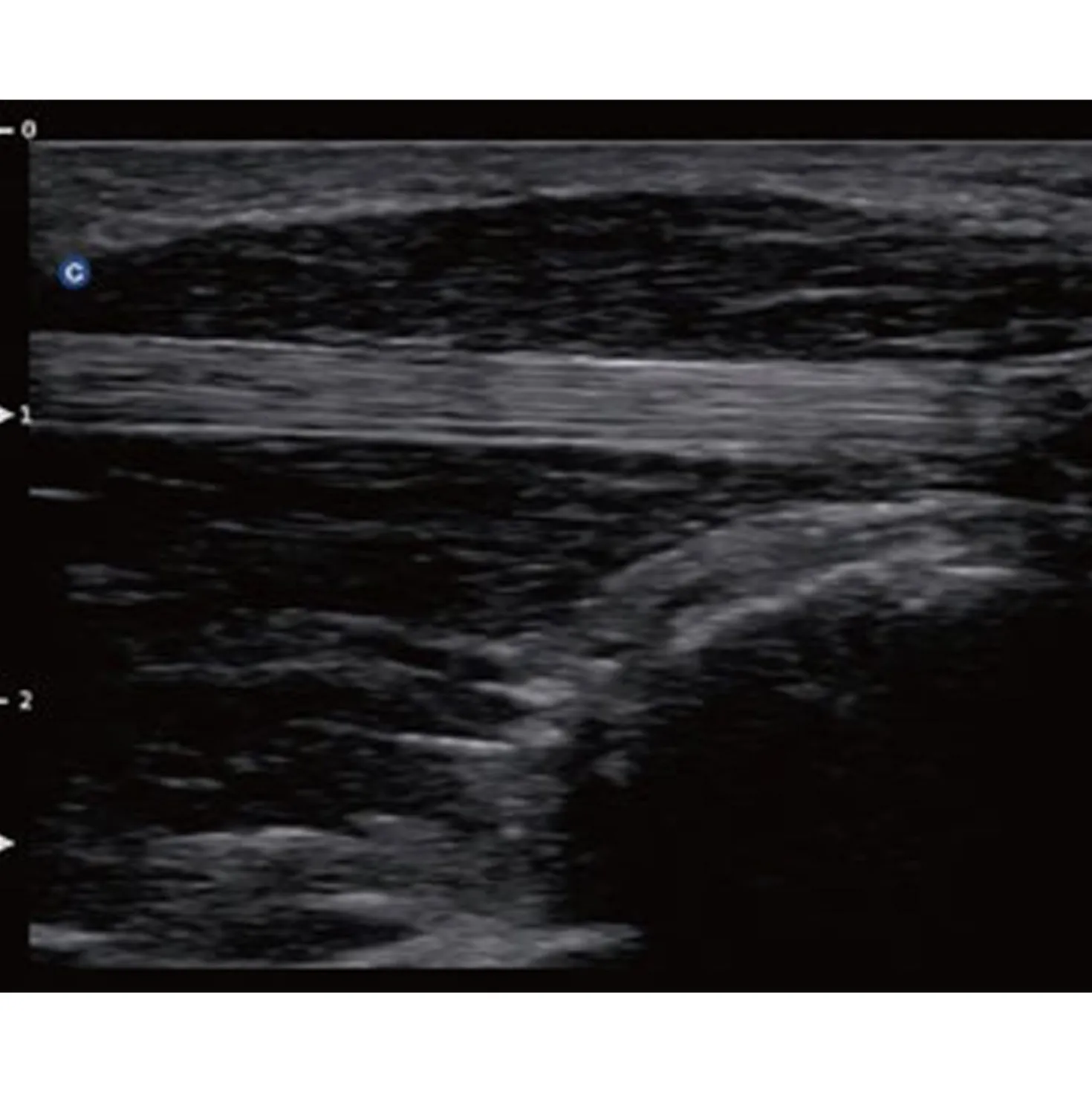QBit5 Ultraschallgerät