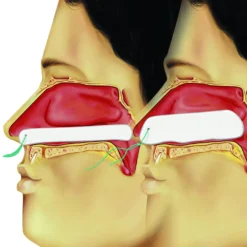 Raucocel Epistaxistamponaden