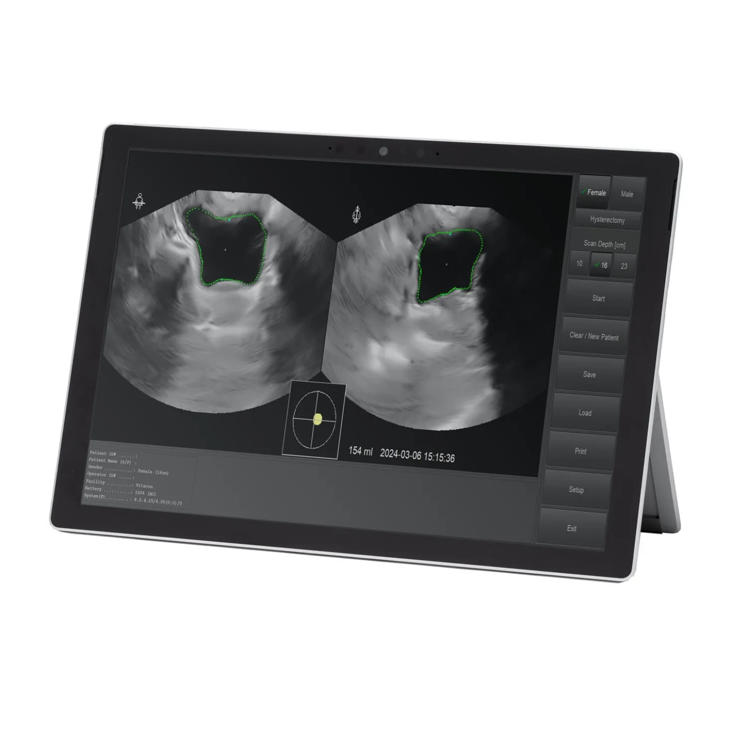 Vitascan LT Blasenscanner